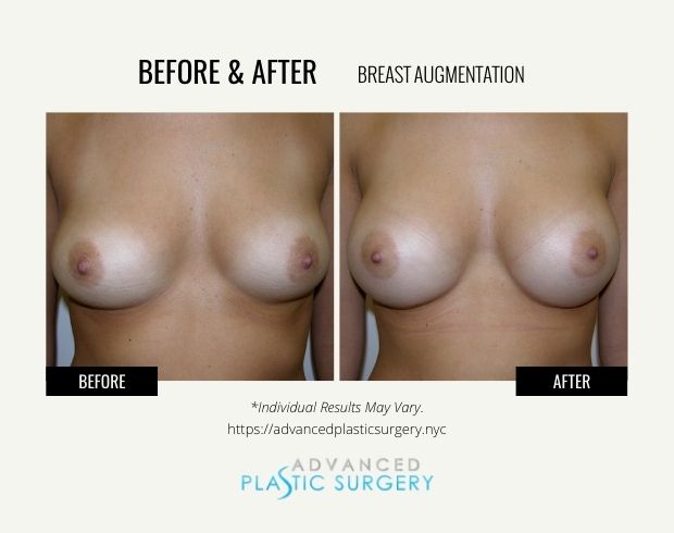 breast augmentation near scarsdale
