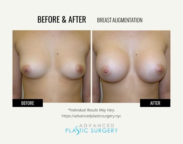 breast augmentation in scarsdale