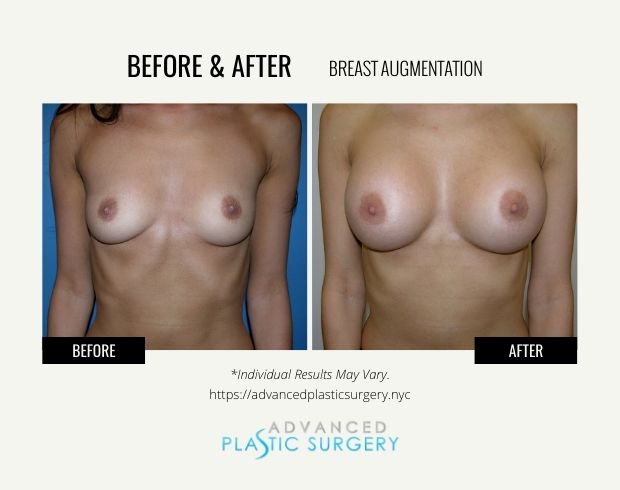 breast augmentation procedure near scarsdale