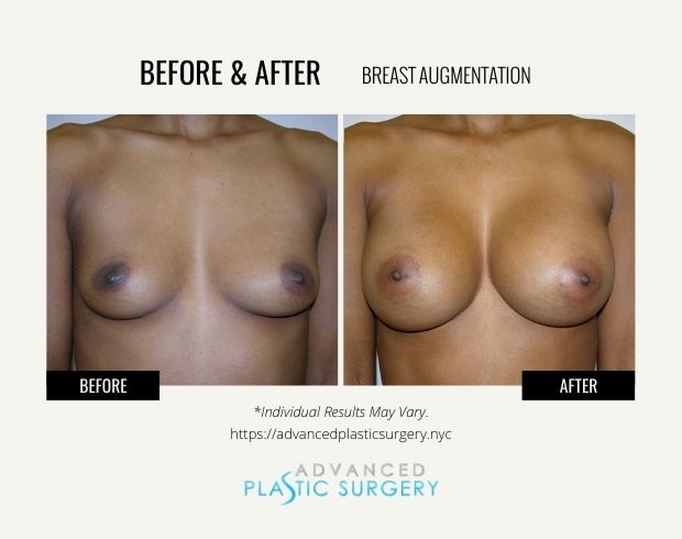 breast augmentation surgery near scarsdale