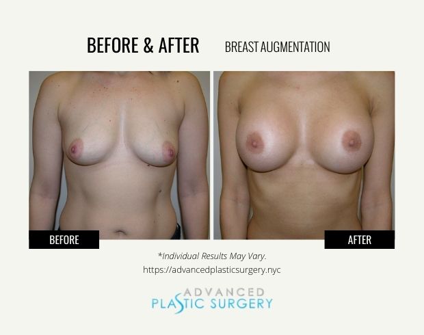 breast augmentation surgery in scarsdale