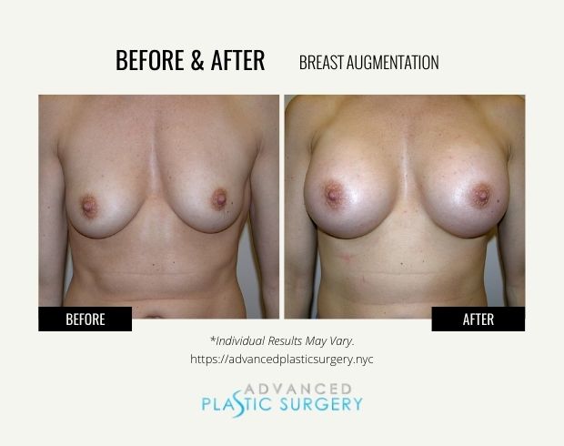 breast augmentation surgery scarsdale