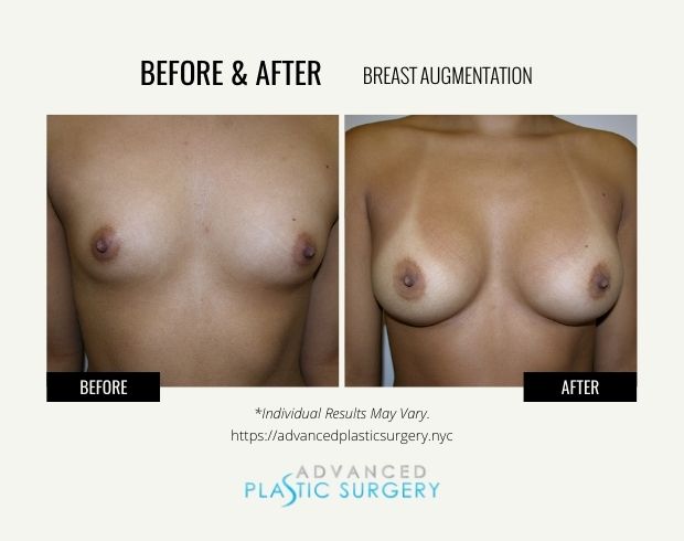 breast augmentation results scarsdale