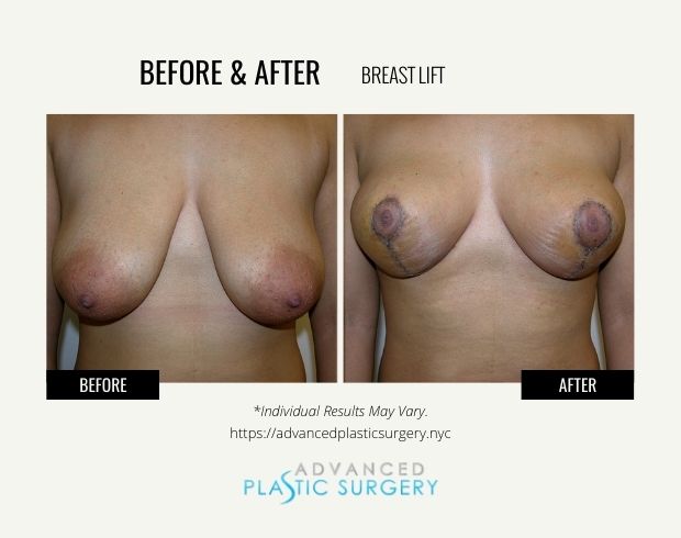 breast lift results scarsdale