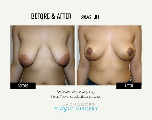 breast lift surgery in scarsdale