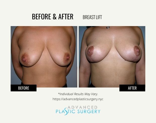 breast lift surgery near scarsdale
