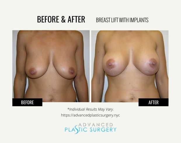 breast lift with implants in scarsdale