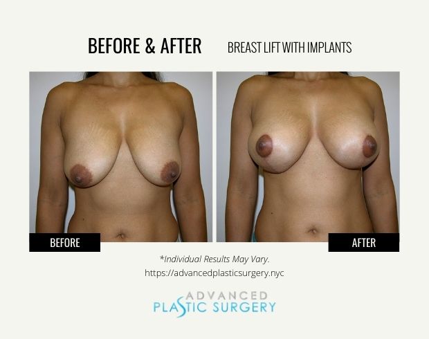 breast lift with implants near scarsdale