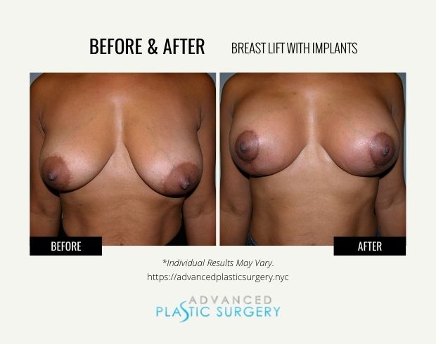 breast lift with implants surgery scarsdale