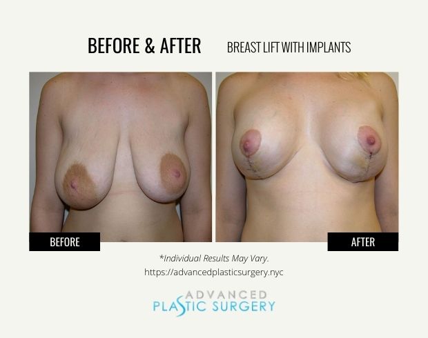 breast lift with implants surgery in scarsdale