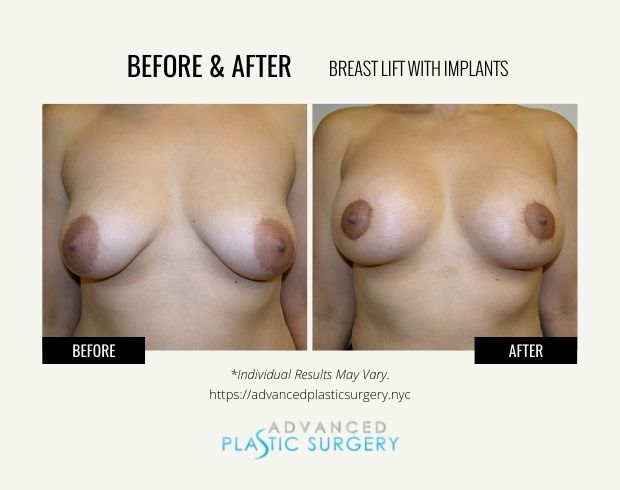 breast lift with implants results scarsdale