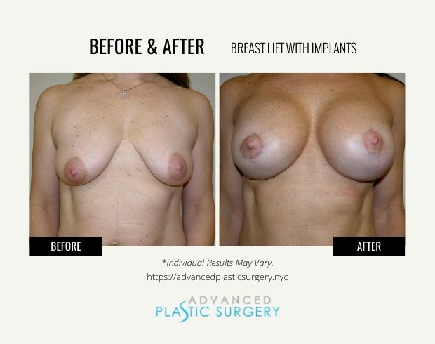breast lift with implants procedure scarsdale