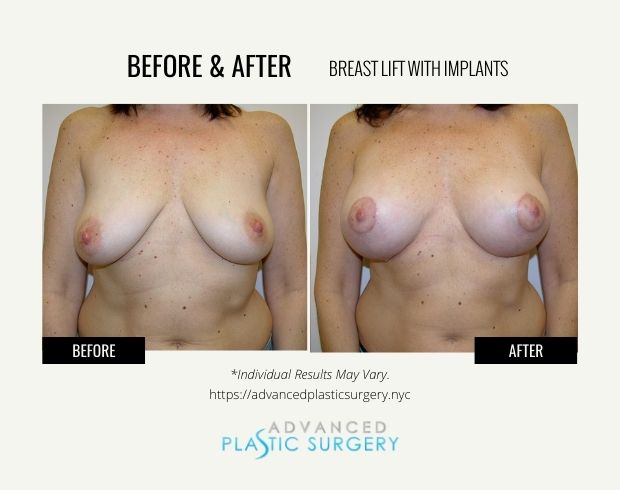 breast lift with implants procedure in scarsdale
