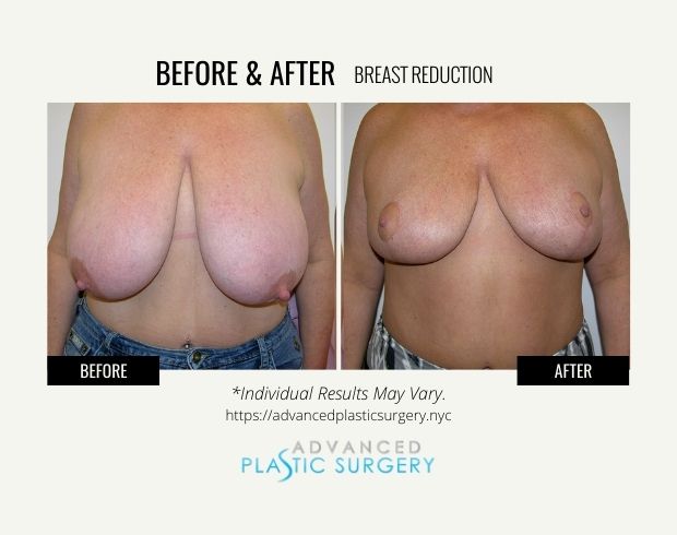 breast reduction near scarsdale