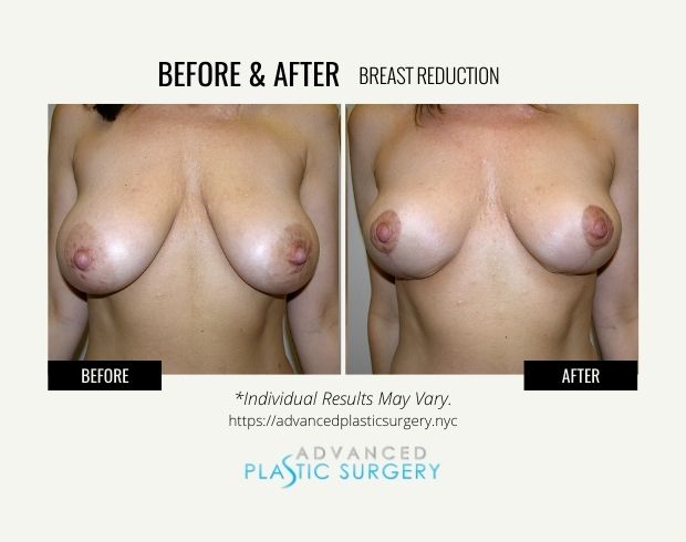 breast reduction in scarsdale
