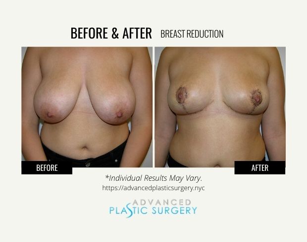breast reduction procedure scarsdale