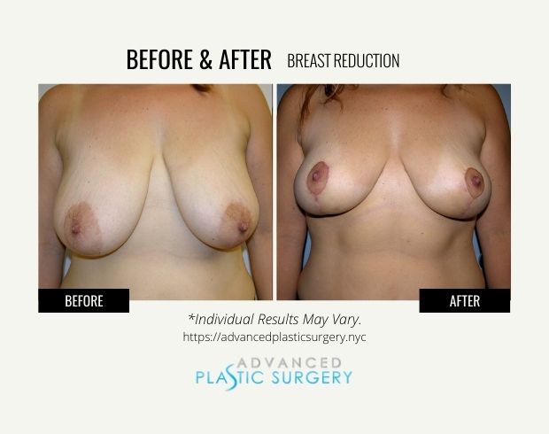 breast reduction surgery scarsdale
