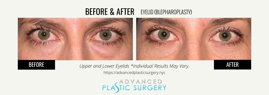 eyelid procedure scarsdale