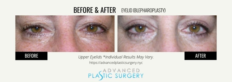 eyelid surgery results scarsdale