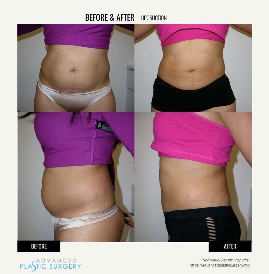 liposuction surgery in scarsdale