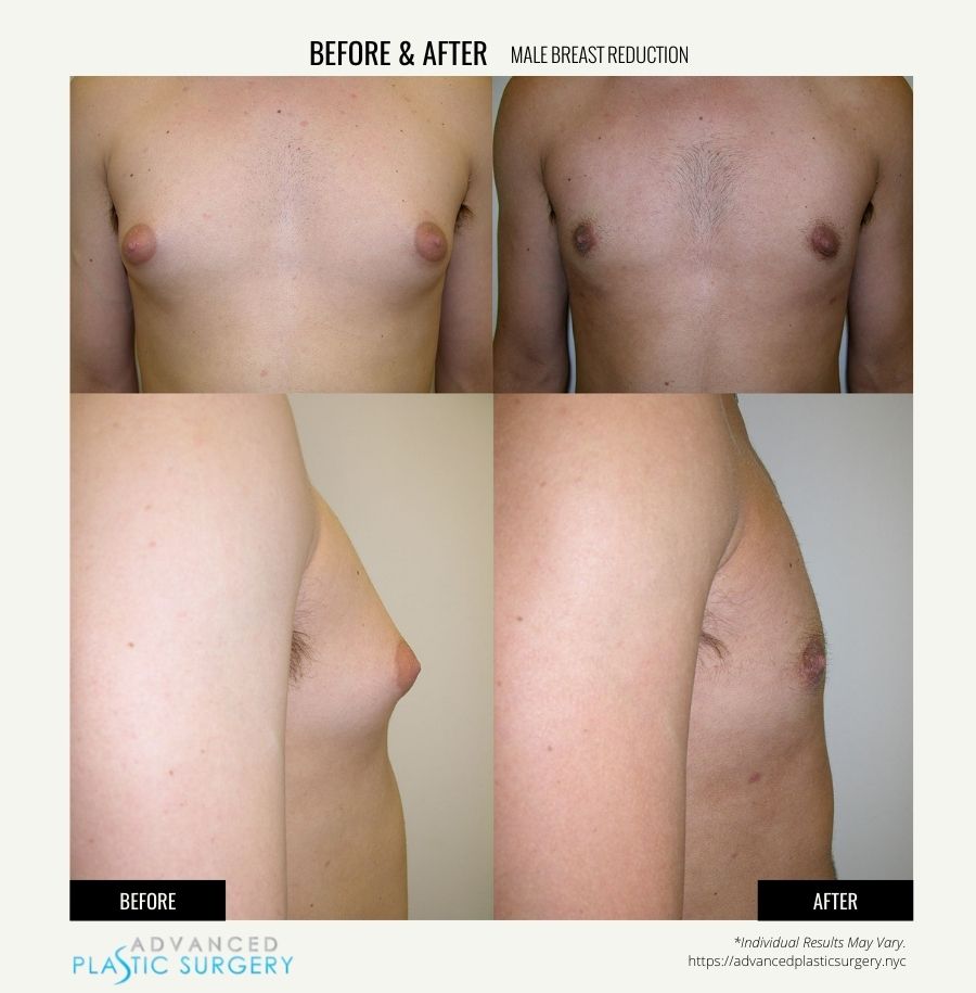 male breast reduction surgery scarsdale