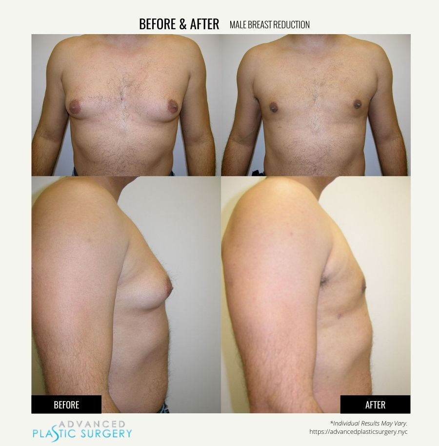 male breast reduction surgery in scarsdale