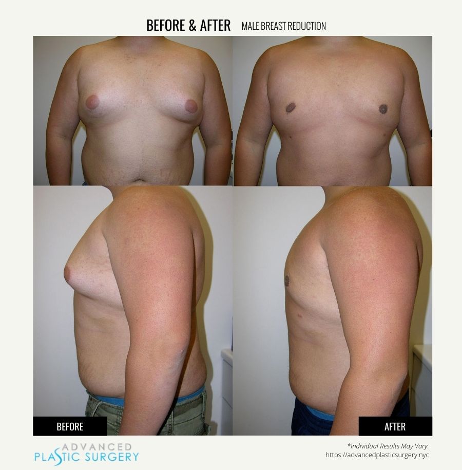 male breast reduction in scarsdale