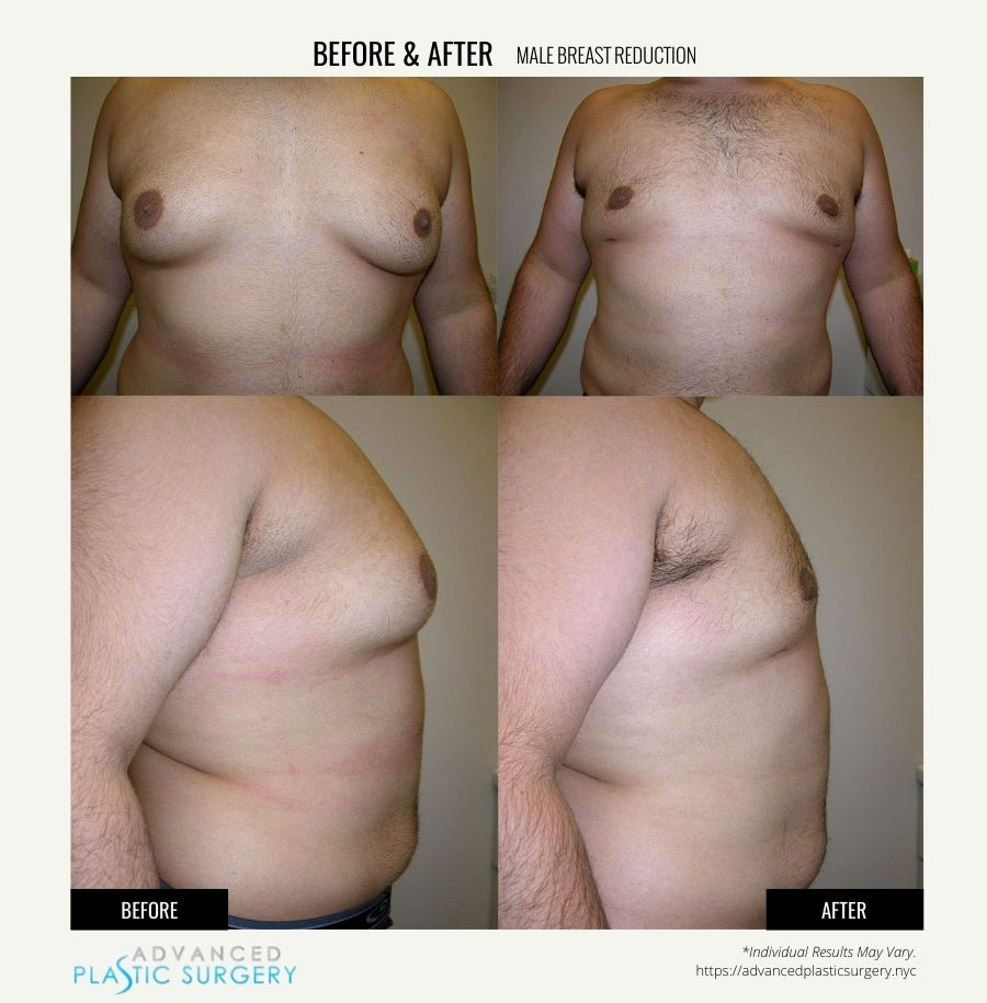 male breast reduction scarsdale