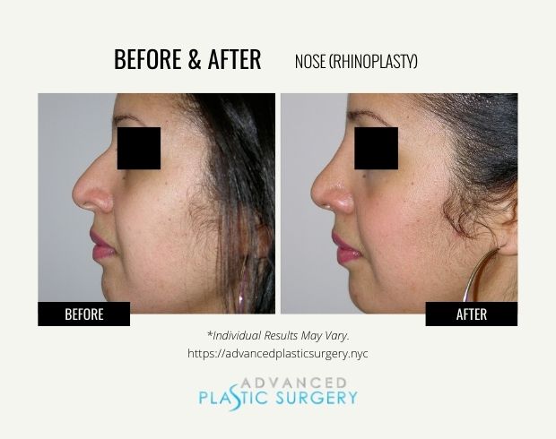 nose rhinoplasty in scarsdale