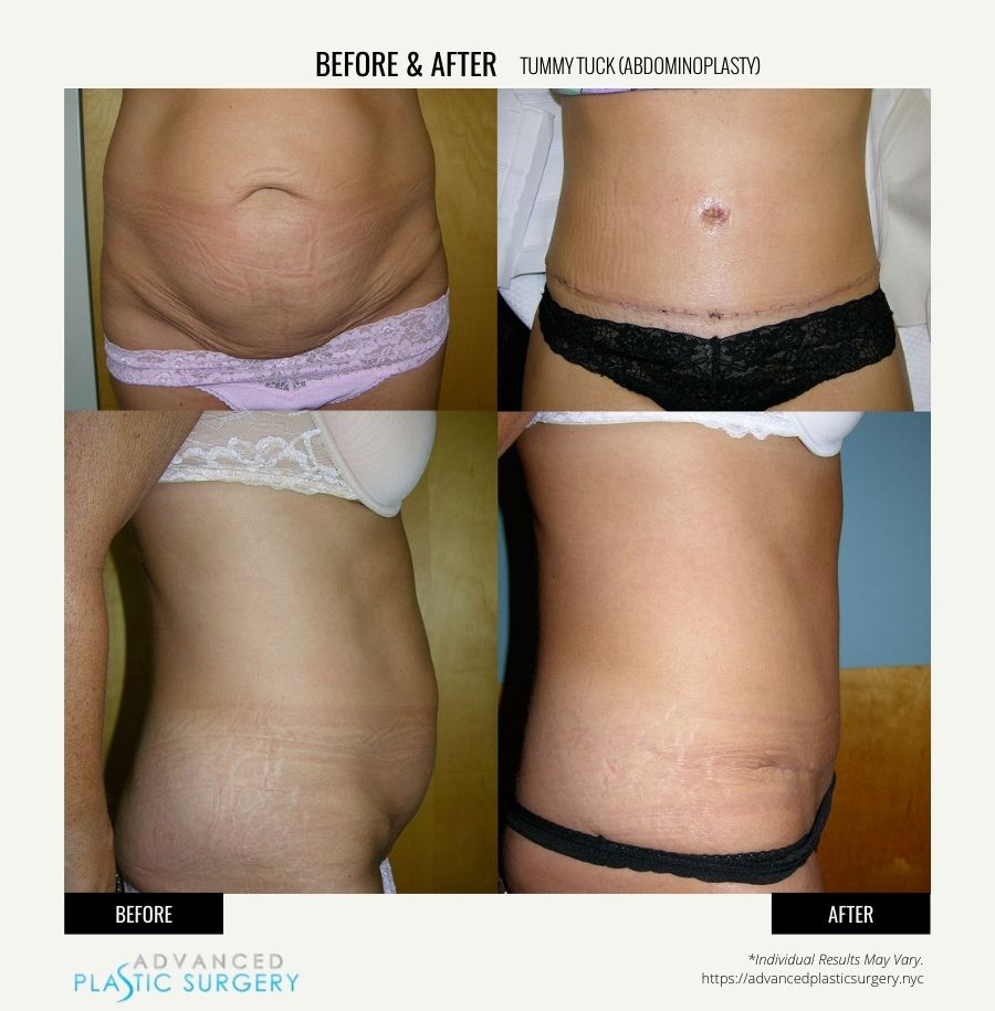 tummy tuck surgery in scarsdale