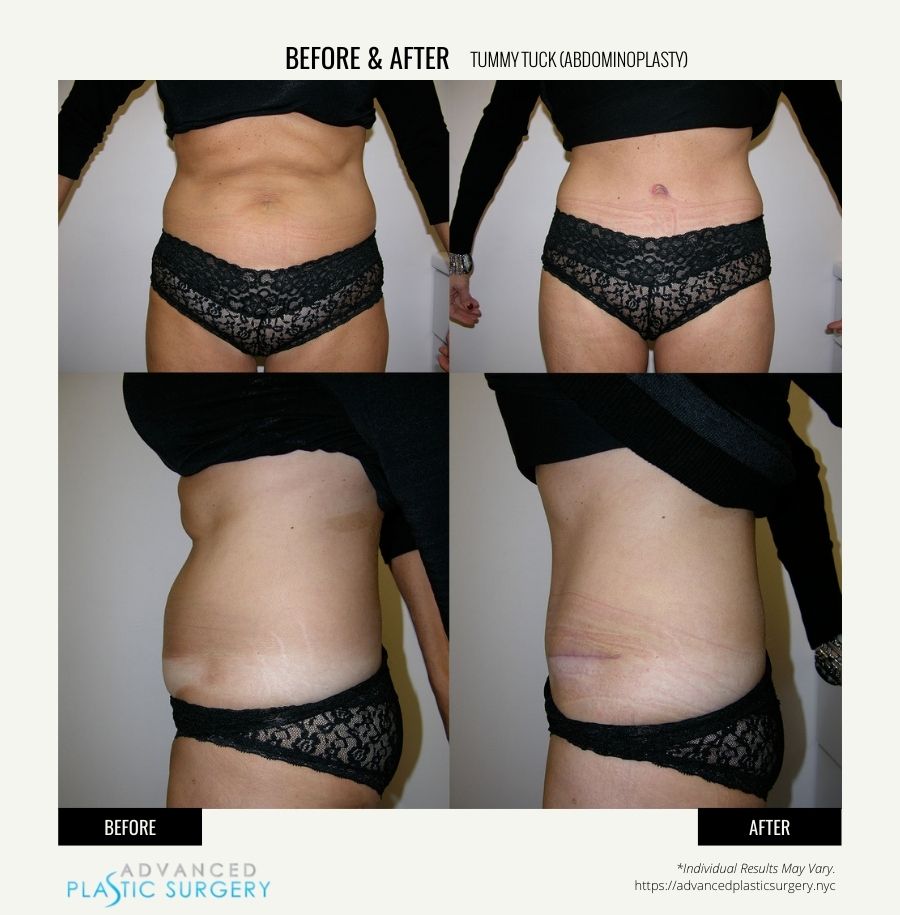 tummy tuck surgery scarsdale