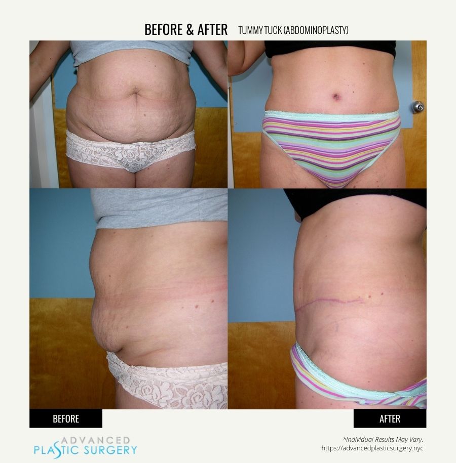 tummy tuck results scarsdale