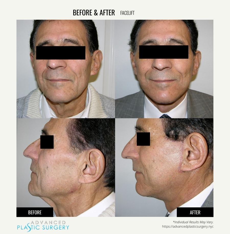 NYC Male Facelifts: Recovery and Transformation — Kassir Plastic Surgery in  NY and NJ