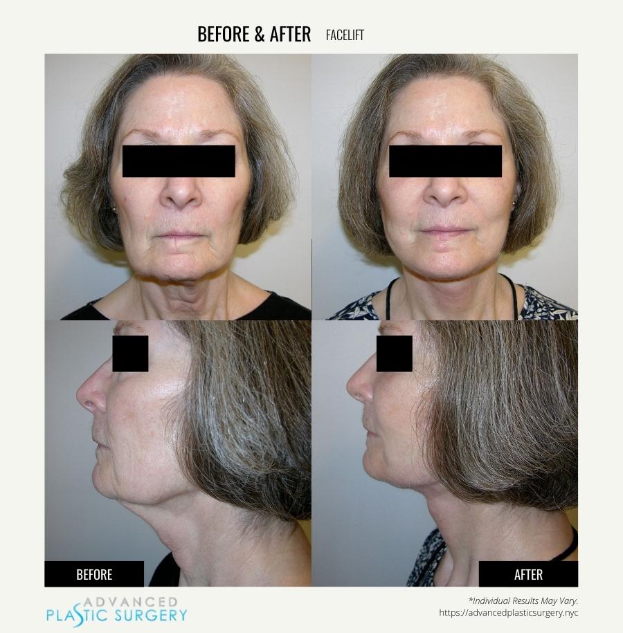 facelift surgery results scarsdale