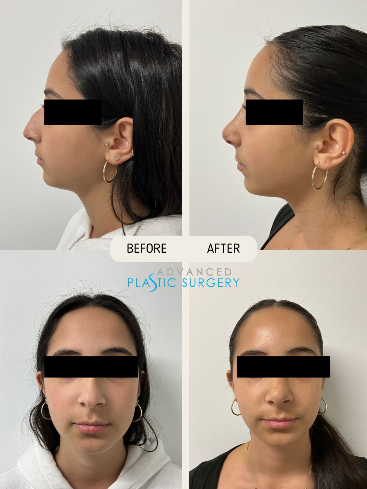 APS_Rhinoplasty_BA_BlogPost - 1